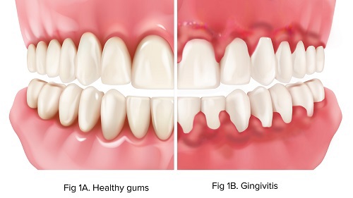 ADA illustration comparing healthy gums with inflamed gums